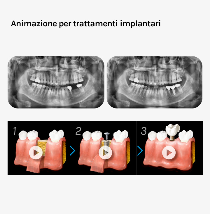 Ez Codi trattamenti implantari