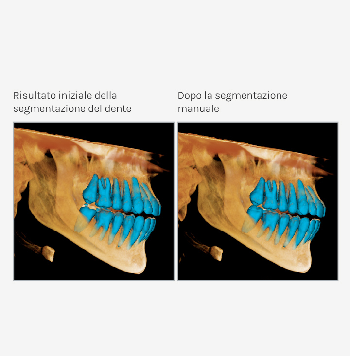 Ez Ortho 3D - Segmentazione manuale