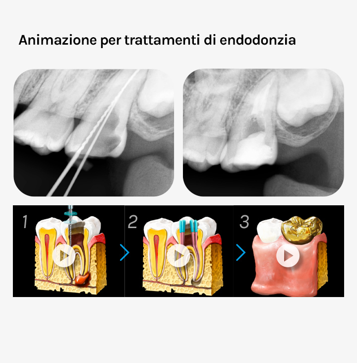 Ez Codi trattamenti di endodonzia