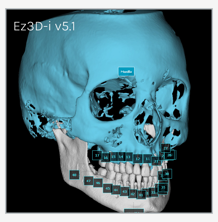 Ez Ortho 3D - Segmentazione rapida